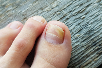 What Causes a Toenail Infection?