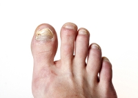 Who Should I See To Treat Toenail Fungus?