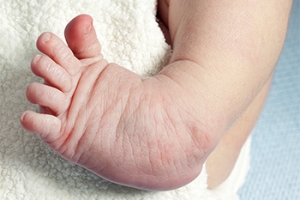 The Definition of Clubfoot