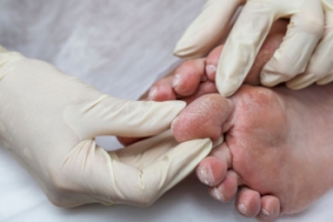 The Importance of Proper Diabetic Foot Care