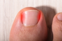 Dealing With an Ingrown Toenail