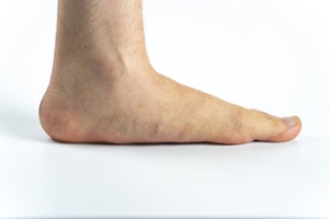 Symptoms and Treatment of Flat Feet
