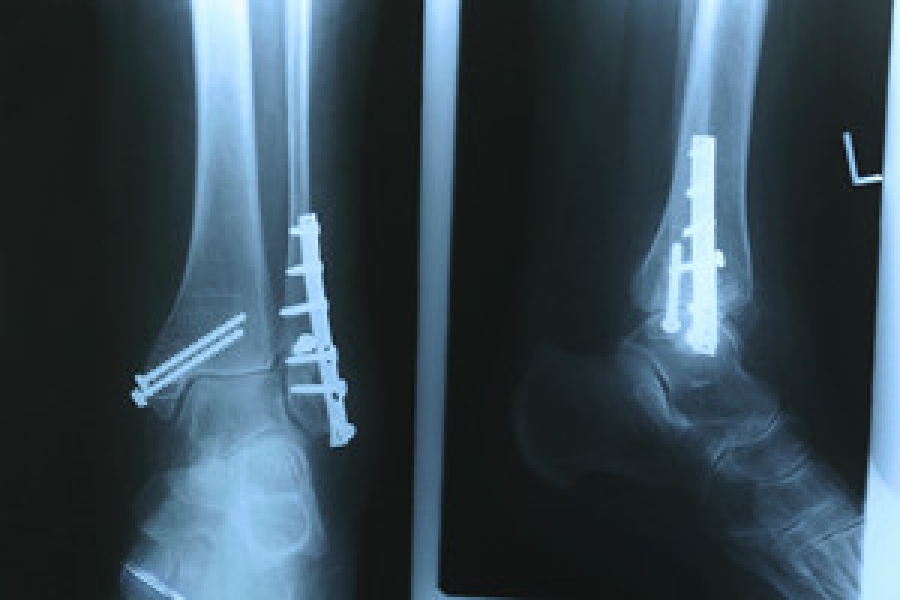 What Is a Stress Fracture?