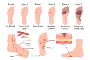 Managing Diabetic Foot Ulcers