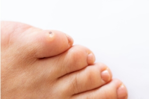 Causes of Corns on the Feet