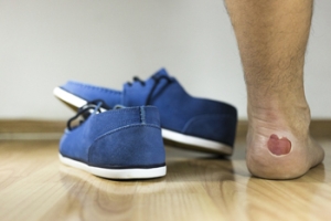 Eczema and Blisters on the Feet