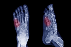 Symptoms of a Jones Fractures